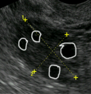 Età e risposta alla stimolazione ovarica: alcune considerazioni