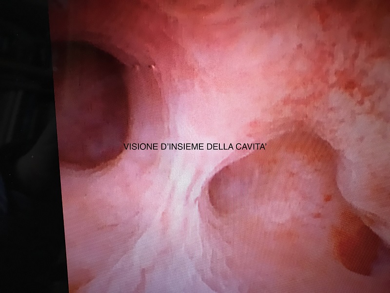 Scopri di più sull'articolo Recettività endometriale e sinechie uterine