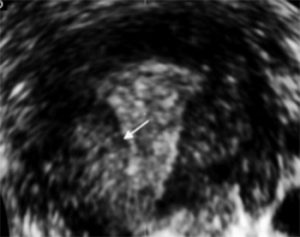 Endometriosi: che cos'è e come incide sulla PMA?