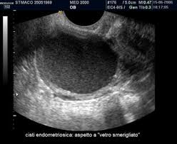 Endometriosi: che cos'è e come incide sulla PMA?