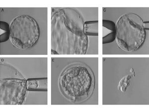 Scopri di più sull'articolo Ripetuti fallimenti di impianto embrionario: perché?