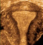 Utero setto, ecografia 3D e aborto ricorrente: alcune considerazioni