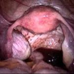 endometriosi pelvica endometrio e pma